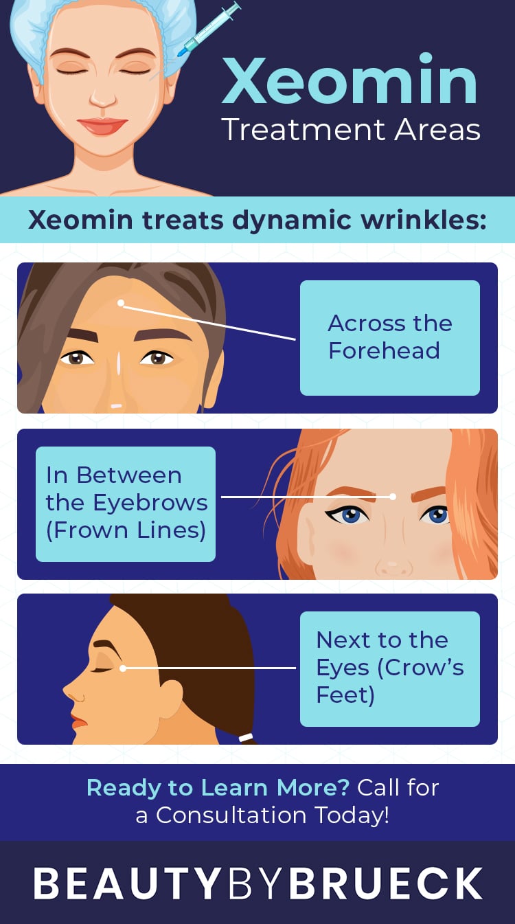 Xeomin treatment area