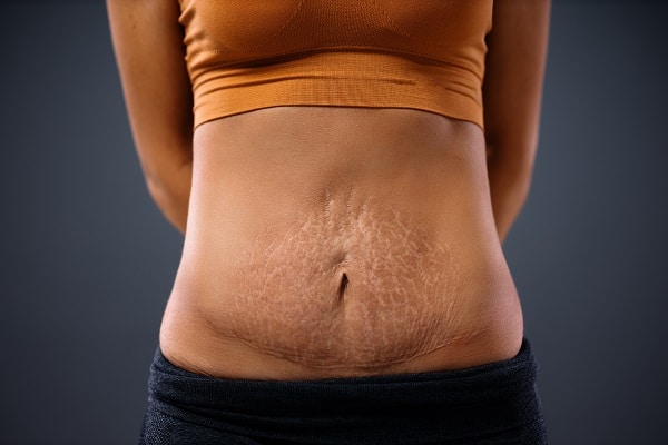 Does Tummy Tuck Surgery Remove Stretch Marks? 656f1b90be885.jpeg
