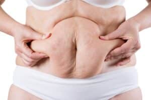 Tummy tuck, flabby skin on a fat belly, plastic surgery concept