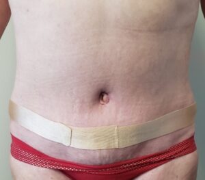 Tummy Tuck