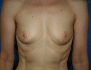 Breast Augmentation