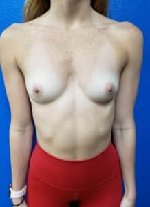 Breast Augmentation