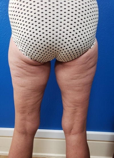 After Image: Thigh Lift - back