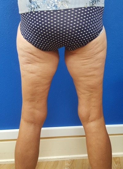 Before Image: Thigh Lift - back
