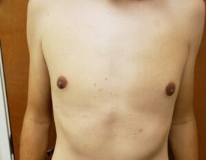 Gynecomastia