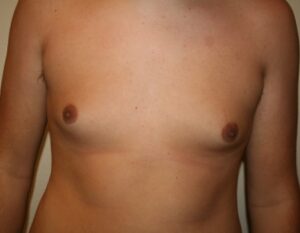 Gynecomastia