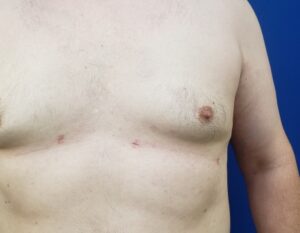 Gynecomastia