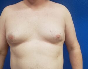 Gynecomastia