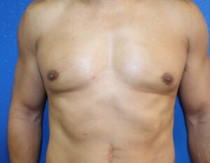 Gynecomastia