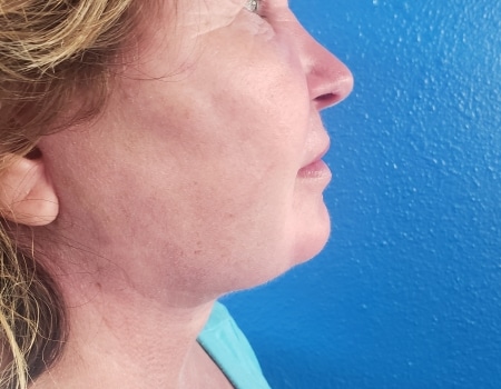 After Image: Facelift and Quicklift - right-side