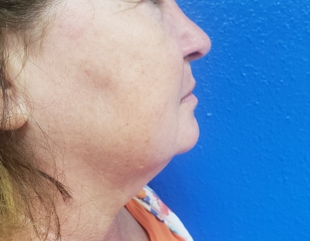 Before Image: Facelift and Quicklift - right-side