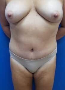 Tummy Tuck