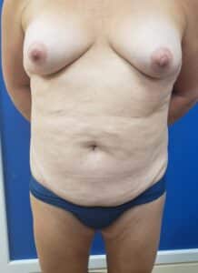 Tummy Tuck