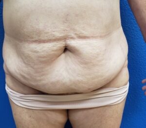 Tummy Tuck