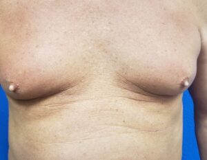 Gynecomastia