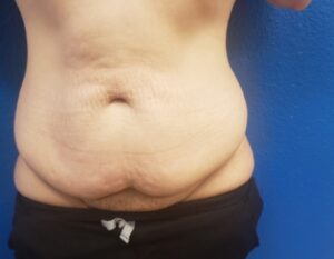 Tummy Tuck